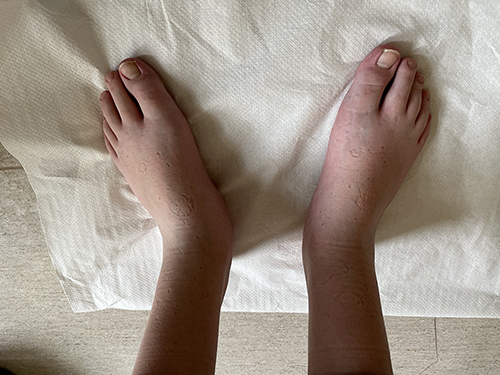 Figure 5 Photograph of the feet of the patient with 2p15 microdeletion syndrome. Note characteristic feature: long slender toes, sandal gap.