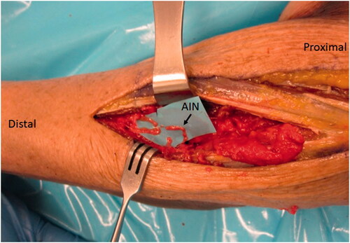 Figure 6. In the case of our patient, three main branches were identified and coapted to the AIN as demonstrated in this representative figure of a left cadaveric forearm.