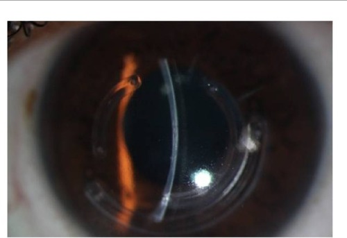 Figure 3 PROSE in keratoconus.