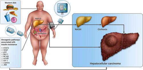 Figure 1 Pathophysiology of the association between metabolic syndrome and hepatocellular carcinoma. Excess body weight, hypertension, diabetes mellitus and visceral adiposity are all components of MetS. At the center of this phenomenon lays insulin resistance and fat accumulation in hepatocytes leading to NAFLD. These factors activate prooncogenic pathways, including JNK, NF-kB, mTOR and STAT3, resulting in a tumorigenic prone environment. There is also an upregulation of IGF-1 and leptin, that results in proliferative, antiapoptotic (p53) and angiogenic effects (VEGF) that lead to cancer cell proliferation. Western diet is associated to signal transduction alterations through changes in cell membrane fluidity and to mitochondrial dysfunction that has also been associated with carcinogenesis. Microbiota is involved in the regulation of bile acids synthesis and metabolism, thus affecting hepatic homeostasis. These processes can lead to HCC through cirrhosis or independently.