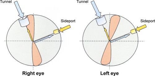 Figure 1 Proper location of the tunnel and sideport incisions for the right-handed superior position surgeon preserving corneal enantiomorphism.