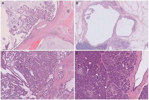 Figure 1. Histological appearance of the subtypes of intraductal papillary mucinous neoplasm of the pancreas. (A) The intestinal type; (B) the gastric type; (C) the pancreatobiliary type; (D) normal pancreas. Image courtesy of Dr Agata Sasor. Printed with permission [Citation19].