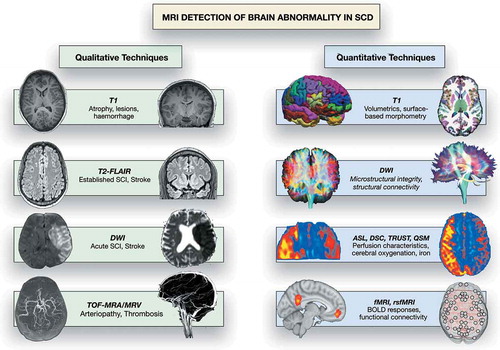 Figure 1. MRI detection of abnormality in SCD, showing common qualitative and quantitative MRI techniques that have yielded insight into neurological complications in SCD patients. DWI: diffusion-weighted imaging; TOF-MRA/V: Time of flight magnetic resonance angiography/venography; ASL: arterial spin-labeling; DSC: dynamic susceptibility contrast; TRUST: T2-relaxation under spin tagging; fMRI: functional MRI; rsfMRI: resting-state functional MRI; BOLD: blood oxygenation level dependent. DWI qualitative images from Hussain Z, Hilal K, Ahmad M, et al. (2 March 2018) Clinicoradiological Correlation of Infarct Patterns on Diffusion-weighted Magnetic Resonance Imaging in Stroke. Cureus 10(3): e2260. doi:10.7759/cureus.2260. MRV qualitative image from https://medpix.nlm.nih.gov/case?id=4510eec0-5199-4e4b-b803-15723ae51c31. rsfMRI connectivity image from Dr Jon Clayden