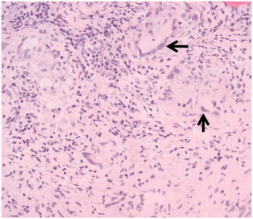 Figure 2. Light microscopic appearance of the excisional biopsy of the lesion demonstrating noncaseating granulomatous inflammation with multinucleated giant cells in the sclera in a patient with scleral sarcoid nodule (original magnification 400×).