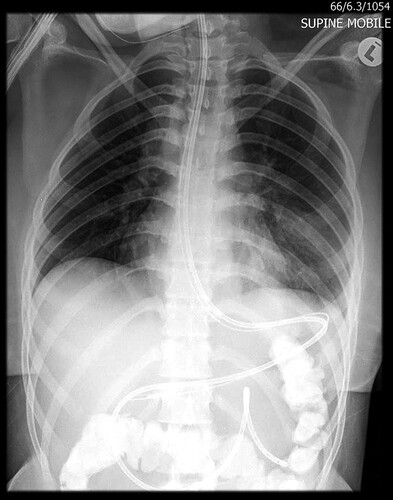 Figure 1: Plain abdominal X-ray post endoscopic placement of a nasojejunal tube confirming placement into the proximal jejunum (image includes a nasogastric tube and colonic contrast).