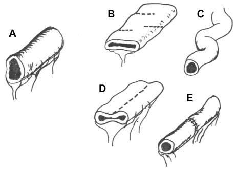 Figure 2 Common enteroplasty techniques using surgical staplers.