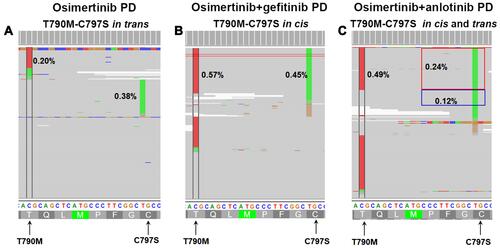 Figure 2 Allelic context and frequencies of EGFR C797S mutation and EGFR T790M mutation during treatments. (A) An in trans configuration at osimertinib PD (progressive disease); (B) an in-cis configuration at osimertinib+ gefitinib PD; (C) both in trans and cis configurations at osimertinib+anlotinib PD.