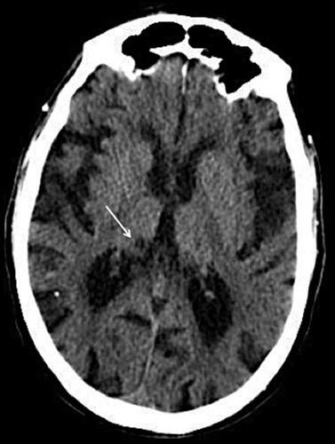 Figure 4 CT-scan: Thalamic infarct.