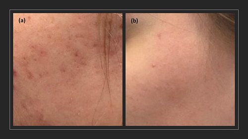 Figure 2 Acne severity (a) before treatment and (b) after treatment of oxybrasion in group A.