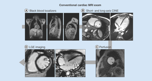Figure 1.  Conventional cardiac MRI exam for boys with Duchenne muscular dystrophy. (A) High-resolution, static, black-blood imaging to evaluate thoracic and cardiovascular anatomy. (B) Dynamic (CINE) white-blood imaging (balanced steady-state free precession) of the left ventricular short- and long-axis to assess regional and global cardiac function. (C) Contrast enhanced perfusion imaging to confirm contrast injection. (D) Post-contrast static late gadolinium enhancement for evaluating myocardial fibrosis (white arrows).CINE: Dynamic image; LGE: Late gadolinium enhancement.