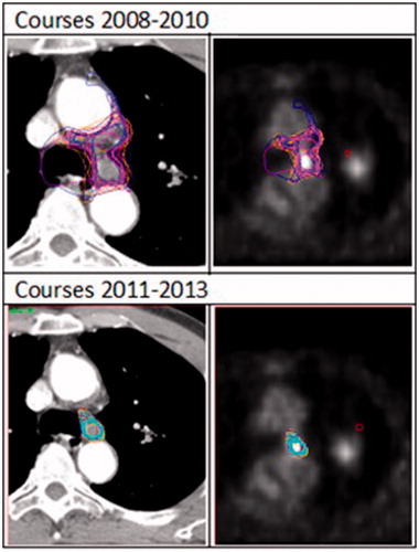 Figure 4. Comparison between the interprofessional collaboration GTVln delineations on CT image 48 between courses held between 2008 and 2010 and courses held between 2011 and 2013. Note an increased reliance on the FDG PET-CT images for the later course leading to a lower interobserver variation.