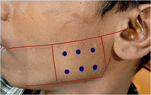Figure 1 Preoperative marking of the 6 injection points.