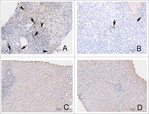 Figure 3. Immunohistochemical studies of adiponectin (A and B, 200X) and adiponectin receptor II (C and D, 200X) in representative liver's sections from chronic hepatitis C patients before anti-hepatitis C virus therapy (A and C) and in controls (B and D). Arrows: adiponectin-positive biliary and endothelial cells; arrow heads: adiponectin-positive hepatocytes.