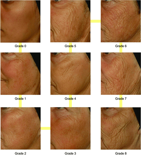 Figure 2 Bazin cheek wrinkles scale.