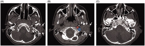 Figure 3. (A) On axial temporal bone CT, the right external ear canal is open. In the left ear, a soft tissue mass (white arrows) surrounds and obliterates the external ear canal between the region of the left temporal bone mastoid (black arrow) and the mandible (white arrowhead). (B) On the more inferior slices, the mass approximates the internal carotid artery (red circle), the internal jugular vein (blue circle), and the superior parapharyngeal area (star). (C) The mass approaches the annulus to within 3 mm (black arrow) and obliterates the external ear canal.
