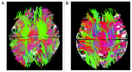 Figure 1. Overall brain tractography from a 62 y-old male Parkinson patient (A) and a 61 y-old male healthy control (B). The color code represents fiber direction: blue-inferior to superior, red - left to right, green- anterior to posterior. The 3D view from the superior plane shows a diffuse reduction of white matter fibers in the PD patient compared with the control.