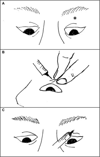 Figure 1 The skin of the upper eyelid was pulled upward under downward gaze in the supine position).
