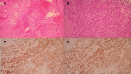 Figure 2 (A) Scar lesion from the pancreas (H&E 100X). (B) The tumor cells are arranged in abnormal and thick trabeculae (H&E 100X). (C) The neoplastic cells are positive for HepPar1 (Immunostain 200X). (D) The neoplastic cells are positive for AFP (Immunostain 200X).