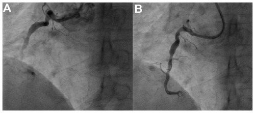 Figure 8 Power position of Hockey stick catheter while performing a difficult right coronary artery angioplasty (distal total occlusion) and straightening of the right coronary artery with deep inspiration.