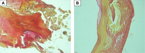 Figure 2 Macroscopic calcification of bioprosthetic leaflet samples, stained with Van Gison, with original magnification ×100. The two panels (A and B) show the morphology of calcification.