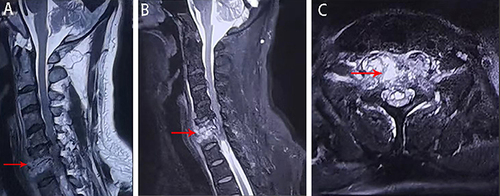 Figure 2 Preoperative MRI. (A) Sagittal T2-weighted MRI image; (B) sagittal fat-suppressed MRI image; (C) axial MRI image of the C6–7 disc space. Red arrows indicate hyperintense signals in vertebral bodies and paravertebral tissue.