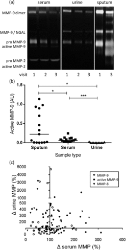 Figure 2.  MMP expression is different in sputum, serum and urine. (a) Representative gelatin zymogram of serum, sputum and urine of a single patient showing different MMP species and complexes in separate compartments. Visit 1: admission during exacerbation, visit 2: exacerbation days 5–7, visit 3: recovery days 28–30. NGAL, neutrophil associated lipocalin. (b) Quantitation of values of active MMP-9 in sputum, serum and urine from 15 patients. (c) Relative change in MMP-8, -9 and active MMP-9 in serum and urine from exacerbation day 1 to recovery days 28–30 in 53 patients. The direction of change was not consistent for any of the MMP species tested.