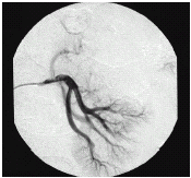 Figure 1. Digital left renal angiogram shows total occlusion of mid-portion lobar artery of anterior division of the left renal artery.