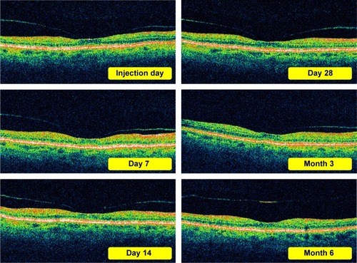 Figure 5 OCT sample pictures of patient with weak traction in the macula after injection of rTPA. (traction dissolving between 3 and 6 months).