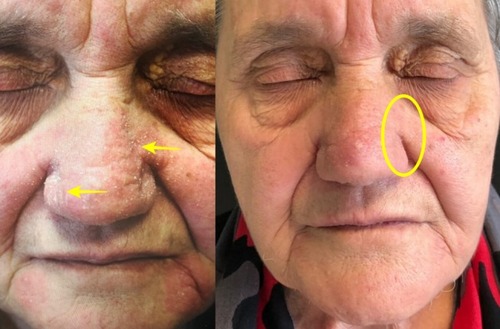 Figure 1 Patient at baseline T0 and T4. In the yellow circle it is possible to see the complete regression of the inflamed and desquamated area (yellow arrows).