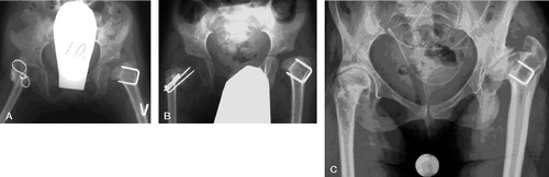 Figure 1. Patient no. 1. A. Preoperatively, showing no femoral head on the right side and the femur positioned considerably more proximally than normal. A valgization osteotomy had been performed previously. A valgization osteotomy had also been performed in the left hip. B. Postoperatively, following transposition of the greater trochanter into the acetabulum on the right side. The subtrochanteric osteotomy was fixated with a Steinman pin. C. 24 years postoperatively, showing a spherical femoral head well covered by a congruent acetabular roof. The cartilage thickness seems adequate. Note the steep femoral neck and the low medial femoral head offset. Severe osteoarthritic changes can be seen in the left hip.