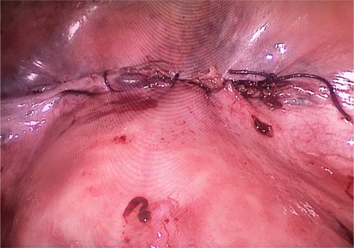 Figure 3 The uterus scar was sutured.