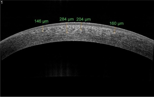 Figure 5 AS-OCT of keratoconus eye 6 months after epi-on corneal cross-linking with iontophoresis imbibition radiating with UV-A at 10 mW/cm2.