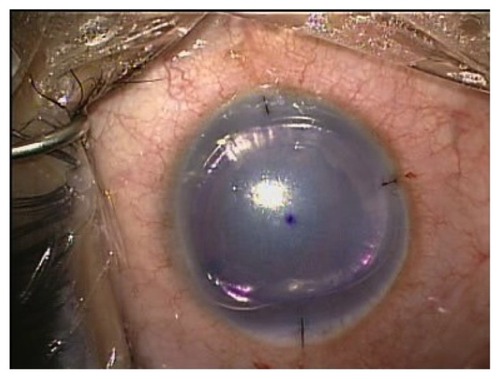 Figure 3 Injection of a large air bubble into the anterior chamber at the conclusion of the procedure.