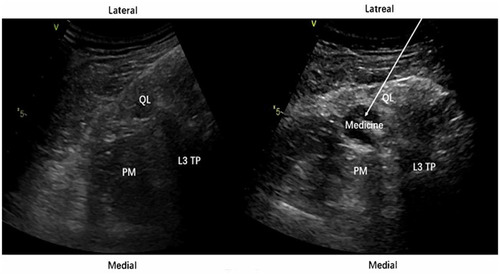 Figure 1 The ultrasound view of the QLB3. Medicine: drug solution. The arrow denotes the puncture path of the needle. Compared with left picture, the psoas muscle in right picture is pressed down by the drug solution.