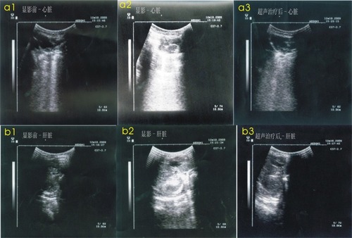 Figure 2 a1) A normal heart ultrasound image before injection of the microbubbles. a2) An increased heart ultrasound image after injection of microbubbles. a3) A heart ultrasound image after the treatment to return it to normal. b1) A normal liver ultrasound image before injection of the microbubbles. b2) An increased liver ultrasonic image after injection of the microbubbles. b3) A liver ultrasound image after the treatment to return it to normal.