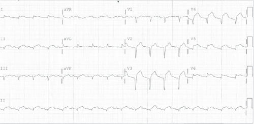 Figure 3 In the second case, the ECG was notable for new Q-waves in inferior and precordial leads as well as ST elevation suggestive of acute ischemia or injury in the anterior-septal leads.