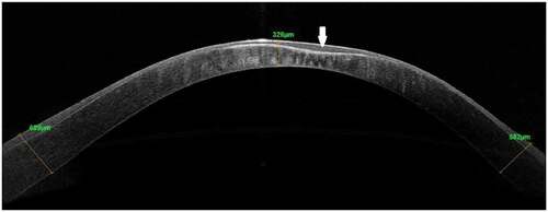 Figure 3. AS-OCT of a keratoconic cornea showing compensatory changes in the epithelial thickness (white arrow) as a response to underlying stromal thinning thus resulting in a regular anterior surface.