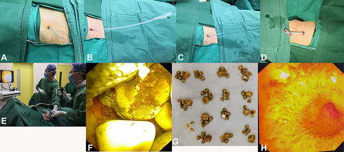 Figure 1 (A) Cut the PTGD drainage tube; (B) dilate the sinus tract with water balloon; (C) insert dilation sheaths into the puncture sinus tract one by one; (D) replace dilation sheaths one by one; (E) insert a choledochoscope into the gallbladder through the dilation sheath; (F) stones in the gallbladder; (G) removed gallstones; (H) unobstructed cystic duct and no residual stone in the gallbladder.