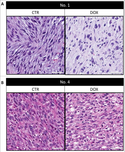 Figure 4. Tumor histology. Tumors from PDOX models 1 and 4 are shown both untreated and after treatment. Scale bars: 50 μm.