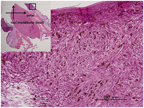 Figure 4. Microscopic photo of the surgical specimen (H&E-stained section). Melanoma cells which contain coarse brownish melanin granules are seen to be spreading laterally in the basal layer of the epithelium and shows invasive growth downward.