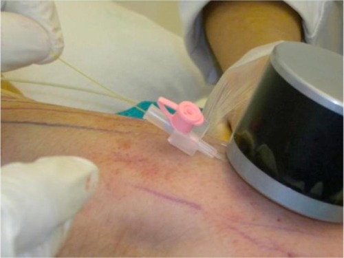 Figure 2 Introduction of a 21-gauge plastic venous catheter and subsequently of the fiber optic laser through an incision in the skin.