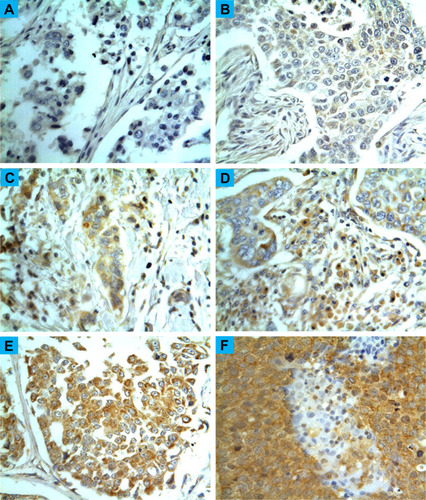 Figure 1 Staining pattern of CYP4Z1expression and different scores of CYP4Z1expression in TNBC. CYP4Z1expression was displayed as clear membranous or cytoplasmic staining. (A) Score “0” showing no expression in the tissue at all. (B) Score “1” showing expression less than 1% of cells. (C) Score “2” showing expression between 1–10% of cells. (D) Score “3” showing expression between 11–33% of cells. (E) Score “4” showing expression in 34–66% of the cells, (F) Score “5” showing expression in more than 67% of the cells. Magnification (X400).