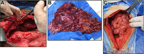 Figure 1 (A and B) Pictures from the surgery in 2017. (A) Part of the field of vision during the operation; (B) the resection specimen of part of the greater omentum. (C) Pictures from the surgery in 2021, the root of the mesentery shrunk into a chrysanthemum shape.