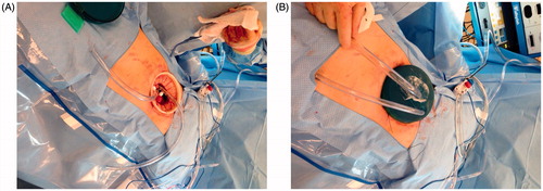 Figure 1. (A) ThermaSolutions inflow/outflow tubing inserted into the abdominal cavity via the Alexis™ ring and base of the GelPort. (B). Placement of inflow/outflow tubing into the GelSeal™ cap.
