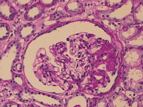 Figure 1.  Light microscopy findings. The glomerulus exhibits segmental sclerosis without vacuolated cells (PAS staining, original magnification ×300).