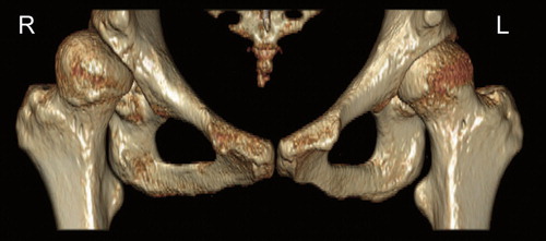 Figure 1. 3-dimensional reconstruction of the hip joints. Hip dysplasia is bilateral with pathomorphological characteristics being distinct in the right hip.