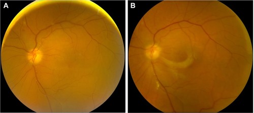 Figure 3 Macula-off rhegmatogenous retinal detachment secondary to acute retinal necrosis (case 3).