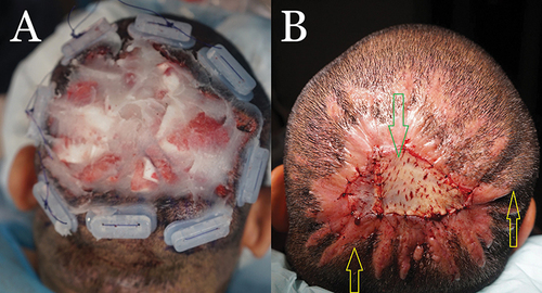 Figure 3 Patient 3: Postoperative FD plaque involving the vertex, and mid-scalp, immediately after applying high-tension sutures with guards in a horizontal mattress fashion. The wound bed is filled with bacitracin antibiotic ointment. (A) At eight weeks postoperatively, a small STSG derived from the anterior thigh is used to close the residual open wound (red arrow). Tenting of skin from tension suture effect is visible (yellow arrows) (B).