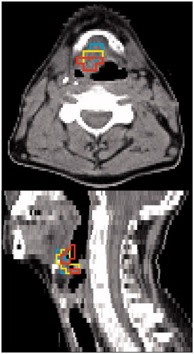 Figure 2. Tumor subvolumes for patient Tue013 shown on the CT of the 2 h p.i. FMISO PET/CT. High overlap with small DTAs is observed between VFDG, VH and VM (cf., Table 1).