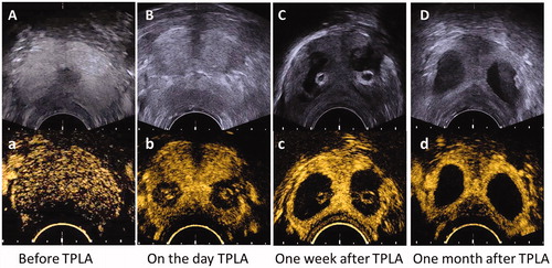 Figure 2. The prostate gland and laser-ablated lesions in beagles prostate were evaluated by TRUS Images (A, B, C, D) and TR-CEUS images (a, b, c, d) before and after TPLA. TPLA: transperineal laser ablation.